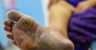 Diabetic Foot Treatment